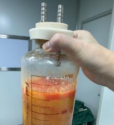 石嘴山水动力吸脂手术要做多久？